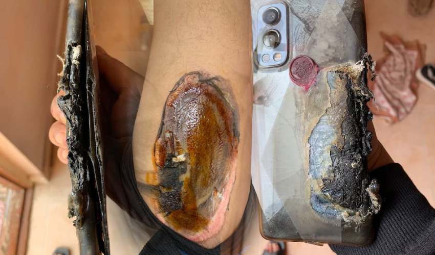 https://10tv.in/national/oneplus-nord-2-5g-allegedly-explodes-causing-severe-burns-2-307228.html
