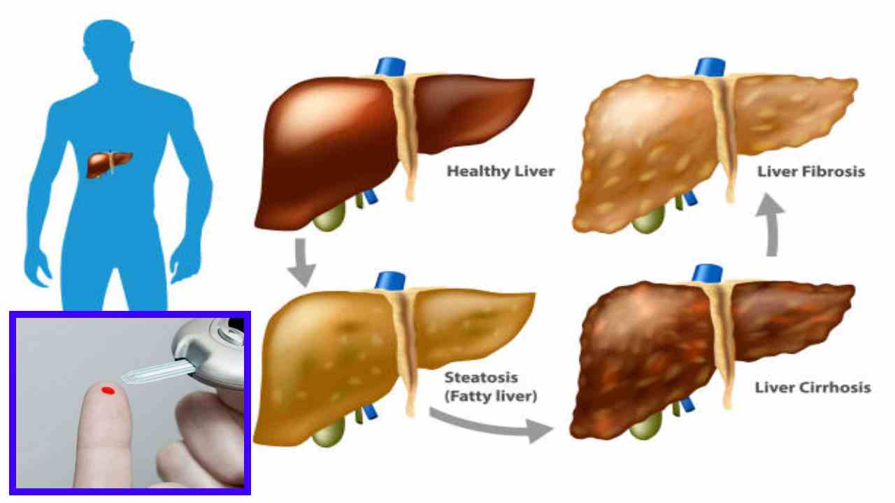 https://10tv.in/life-style/how-to-protect-the-diabetes-liver-410627.html