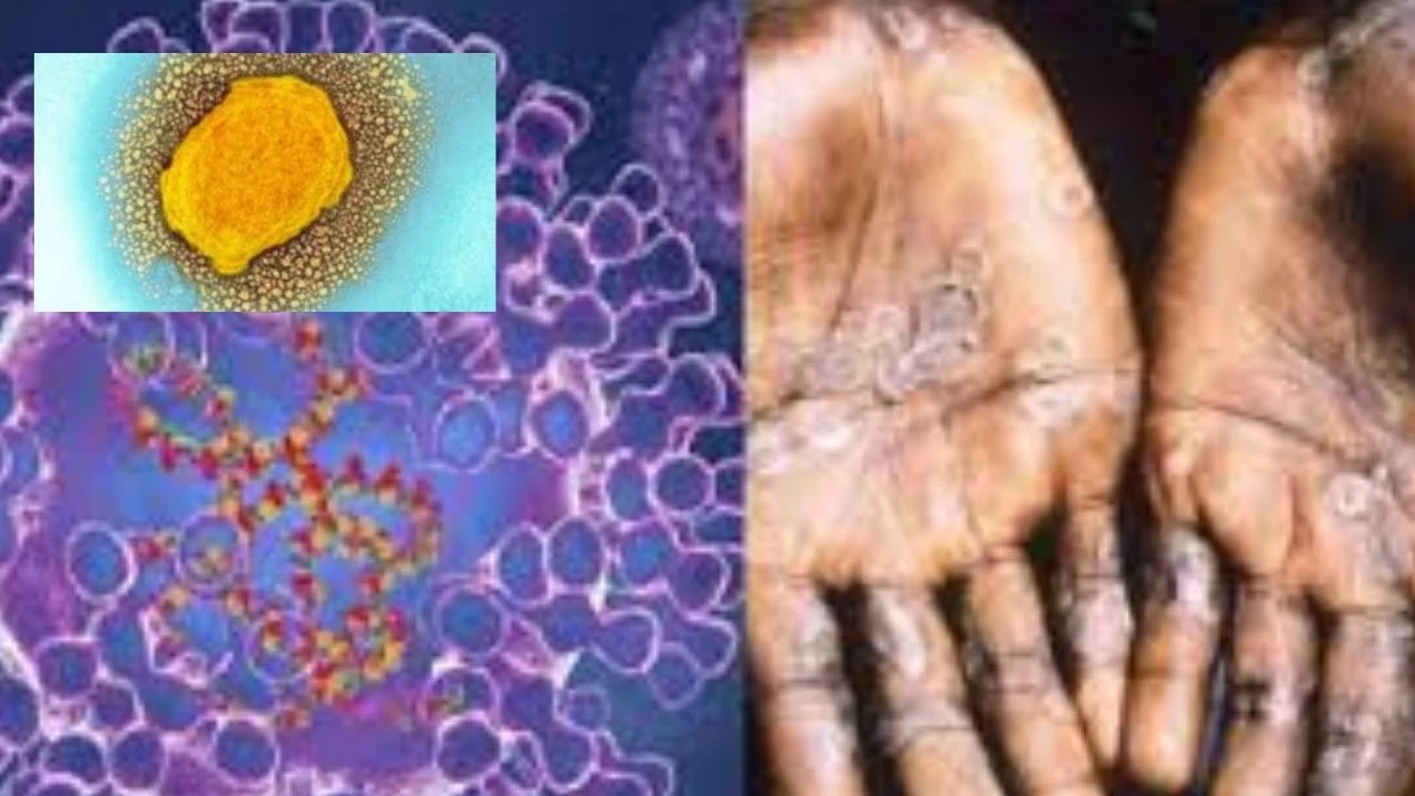 https://10tv.in/international/the-british-health-care-agency-revealed-that-monkeypox-can-be-transmitted-through-homosexual-contact-432075.html