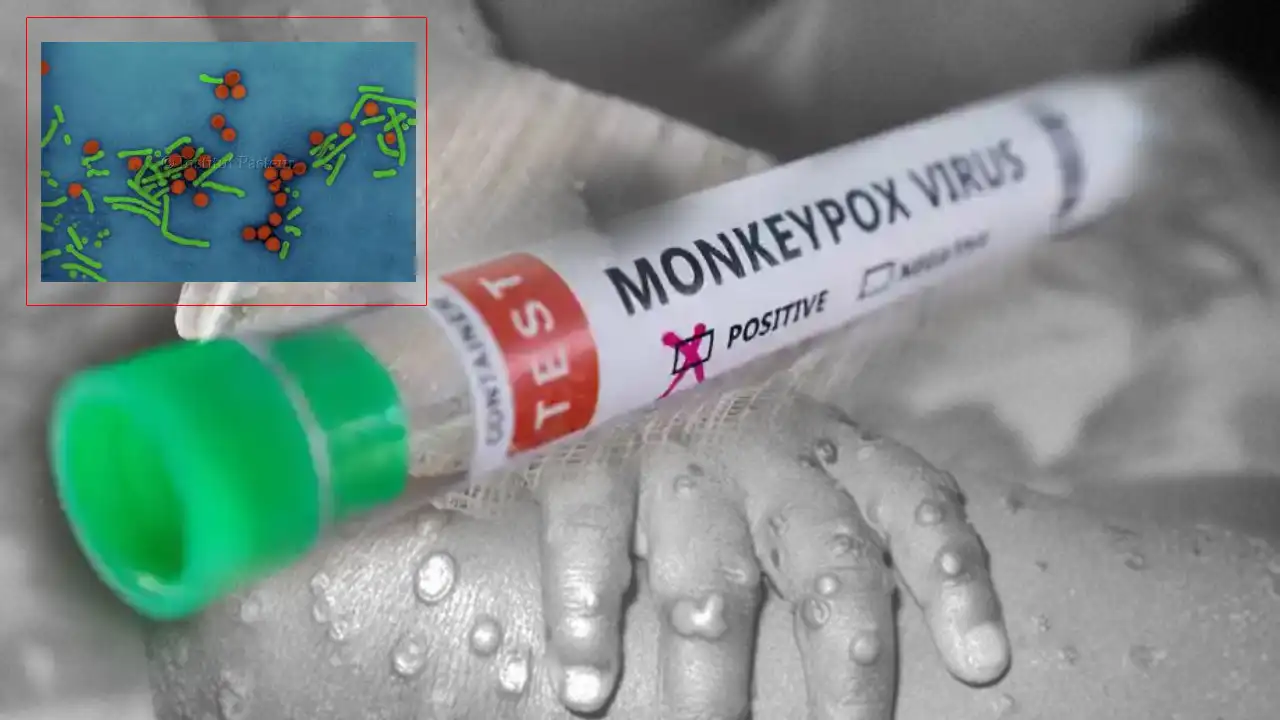 https://10tv.in/international/who-expects-more-monkeypox-cases-globally-432164.html