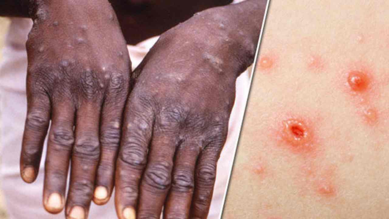 https://10tv.in/international/who-says-no-urgent-need-for-mass-monkeypox-vaccinations-432160.html
