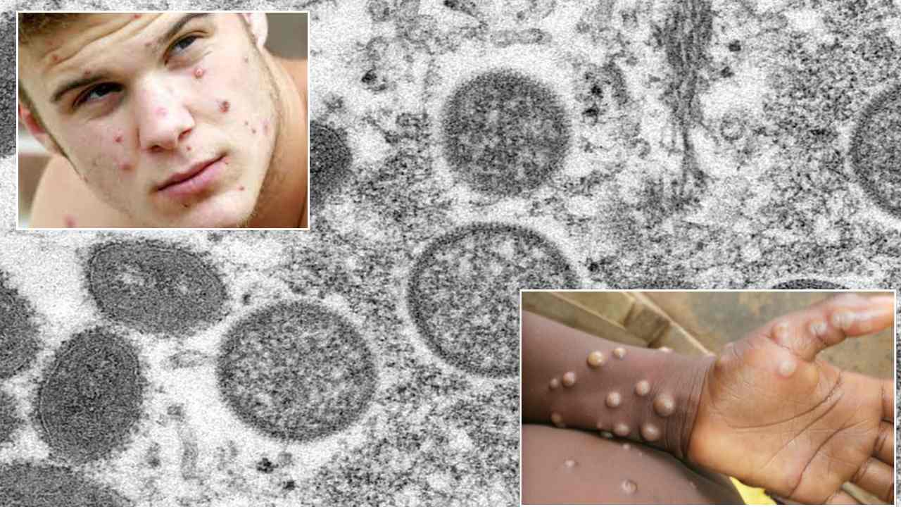 Monkeypox cases : 11 దేశాల్లో 80 మంకీపాక్స్‌ కేసులు.. అయినా ఆందోళనక్కర్లేదు.. నిపుణుల సూచన!