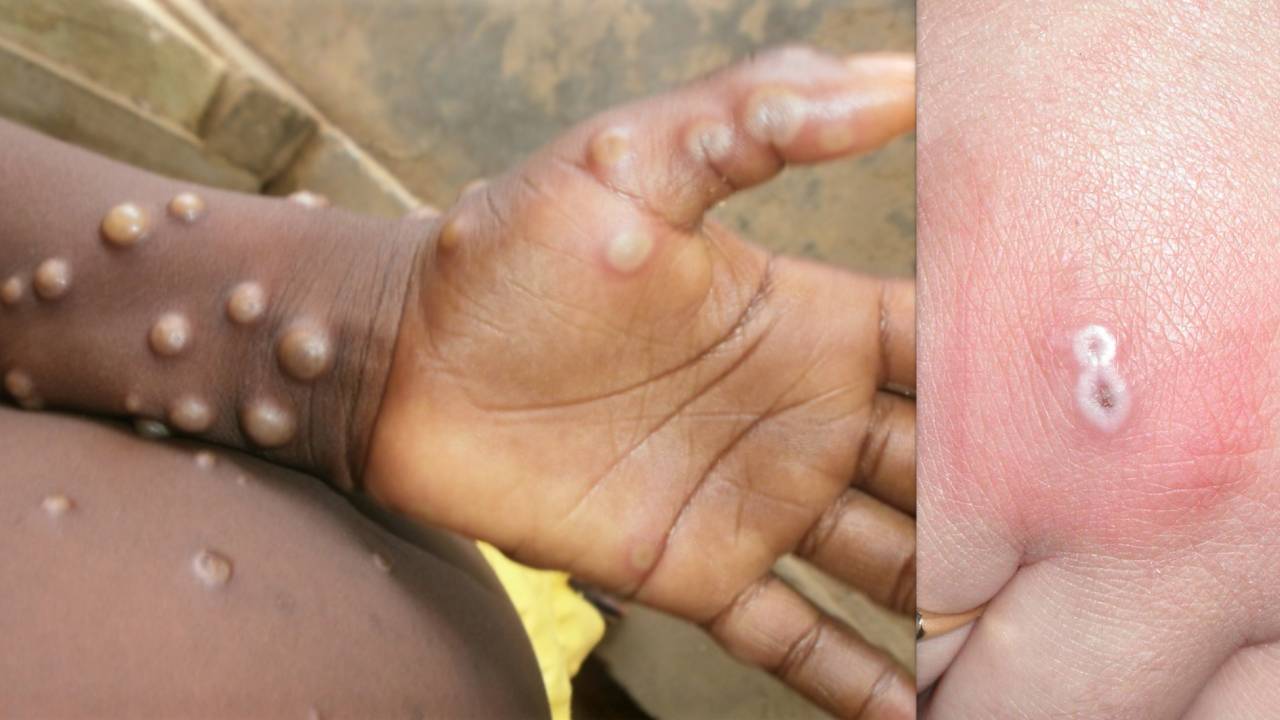 Monkeypox: ప్రపంచ వ్యాప్తంగా పెరుగుతున్న మంకీపాక్స్ కేసులు.. అప్రమత్తమైన కేంద్రం