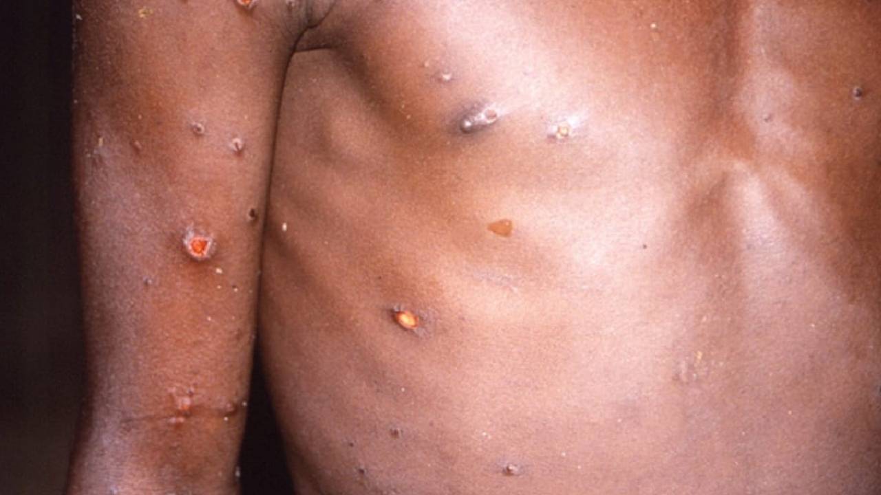https://10tv.in/latest/will-the-monkeypox-outbreak-turn-into-another-pandemic-435125.html