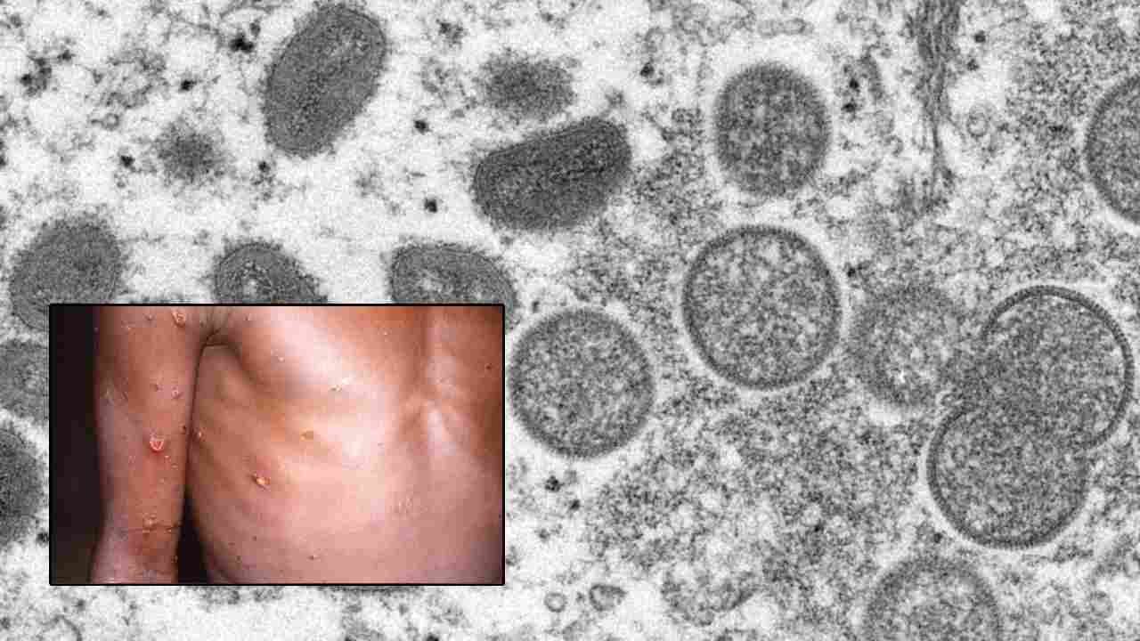 https://10tv.in/international/us-confirms-monkeypox-1st-case-who-travelled-to-canada-429080.html