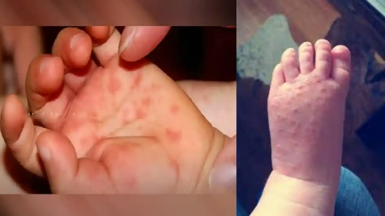 https://10tv.in/latest/tomota-fever-in-kerala-over-80-kids-reportedly-infected-424723.html