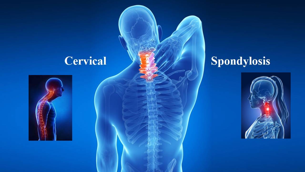 Cervical Spondylosis: సర్వికల్ స్పాండిలోసిస్ కోసం 5 యోగాసనాలు
