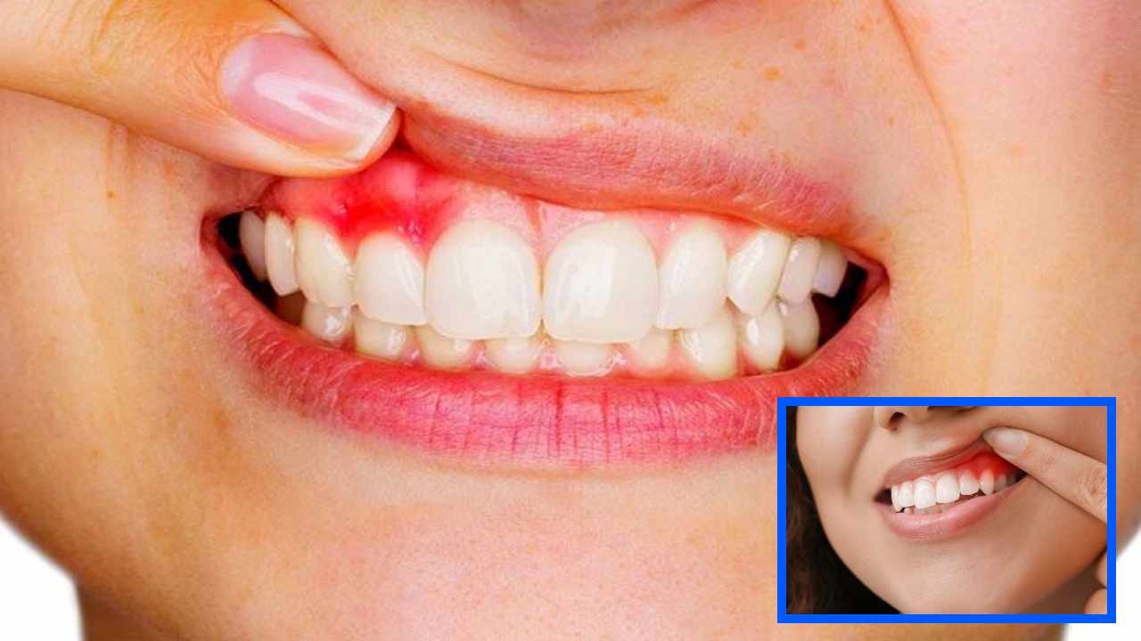 https://10tv.in/life-style/gingivities-diseases-in-mouth-453054.html