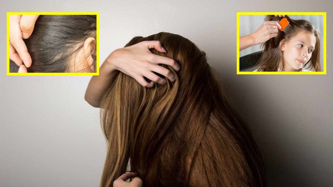 https://10tv.in/life-style/are-you-suffering-from-the-problem-of-head-lice-453004.html