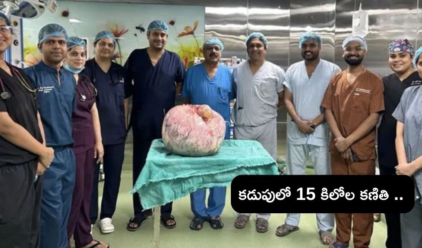 Fifteen kgs tumor from a woman stomach