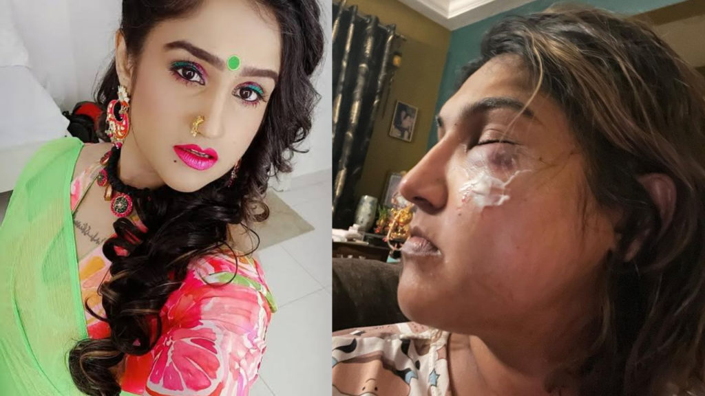 Tamil Actress Vanitha Vijay Kumar had injured post viral