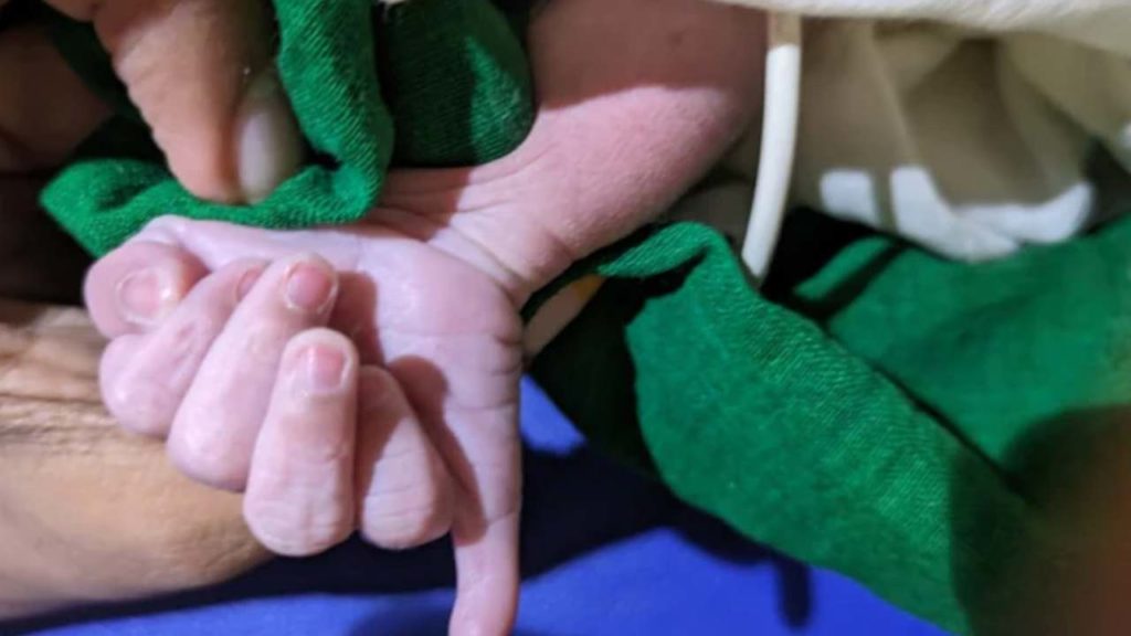 Baby born with 25 fingers